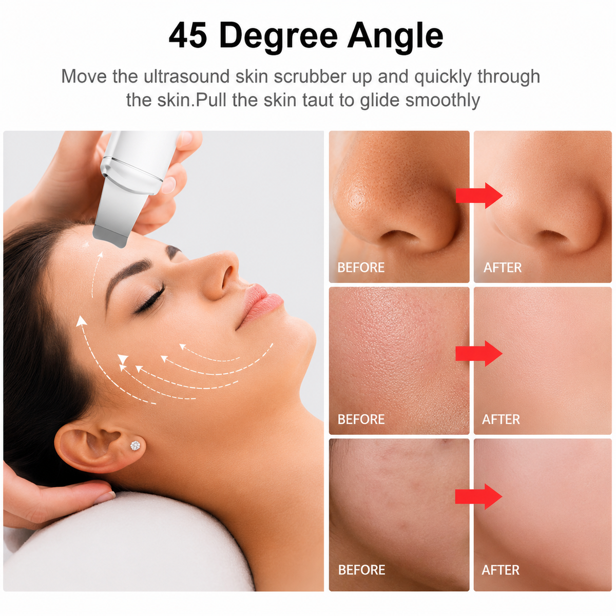 Ultrasonic Face Blackhead Remover Spatula